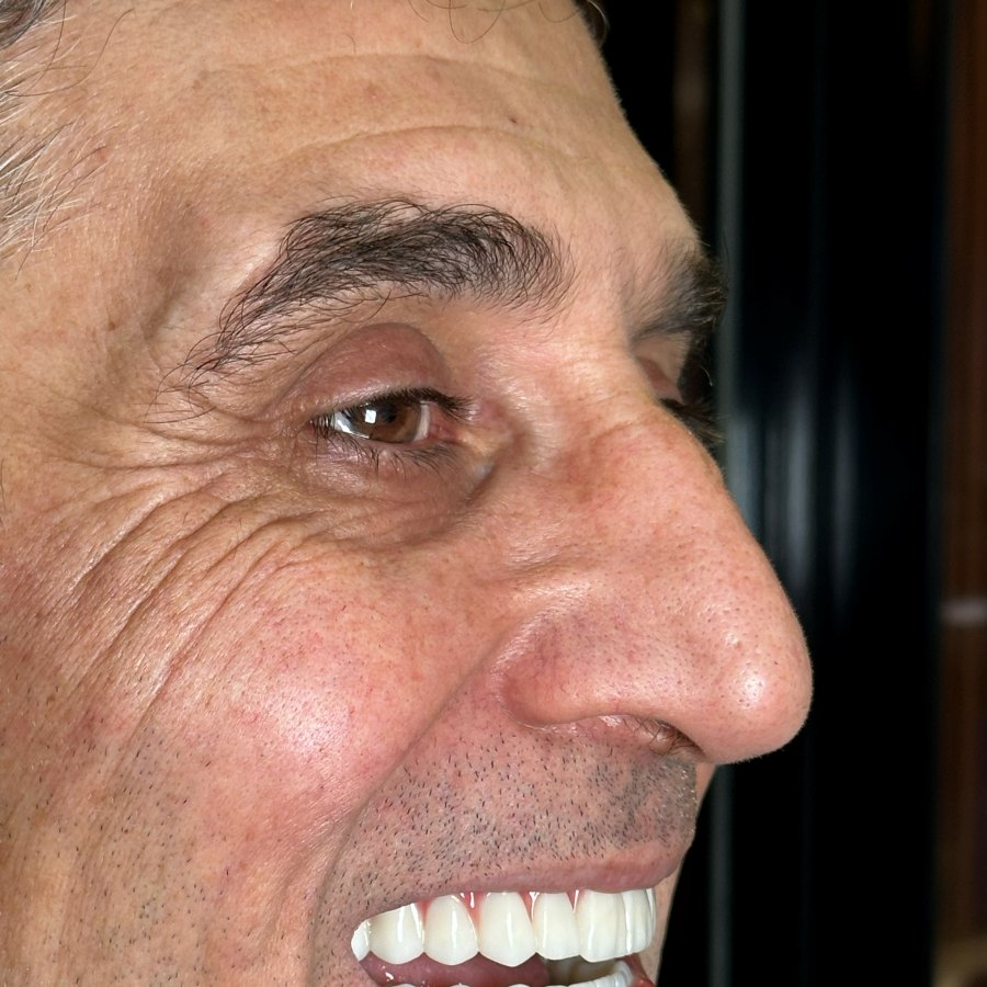 Deltadiş hasta vakası