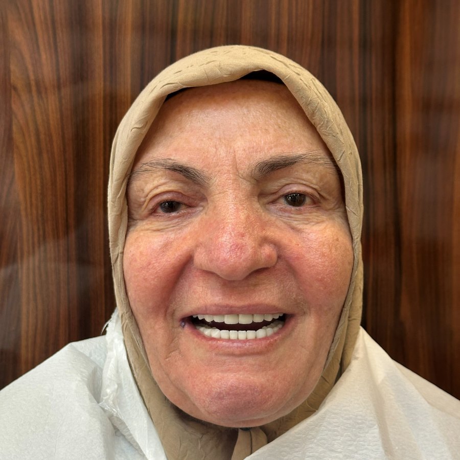 Deltadiş hasta vakası